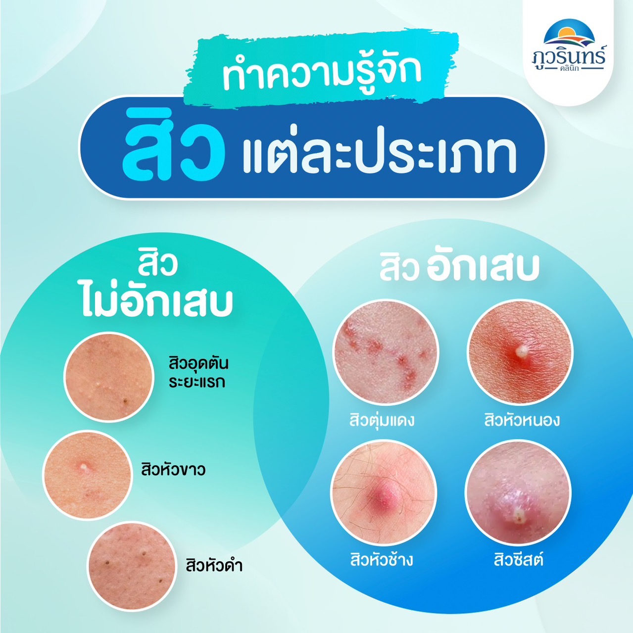 ทำความรู้จักสิวแต่ละประเภท สิวไม่อักเสบ และสิวอักเสบ ภูวรินทร์คลินิก