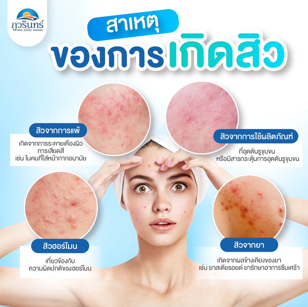 เคสสิวและรอยหลุมสิว ภูวรินทร์คลินิก